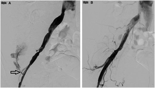 (A) Right iliac artery angiography showed contrast medium extravasation from the right superficial circumflex iliac artery (arrow). (B) No residual extravasation following right external iliac artery stenting.