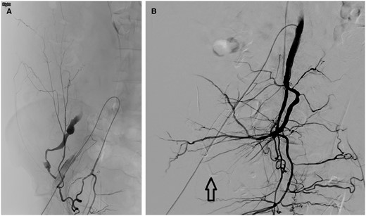 (A) Right obturator artery angiography showed contrast medium extravasation from the previous haemorrhage site. (B) Right internal iliac angiography showed no residual extravasation. Arrow points to glubran and lipiodol mixture used for embolization.