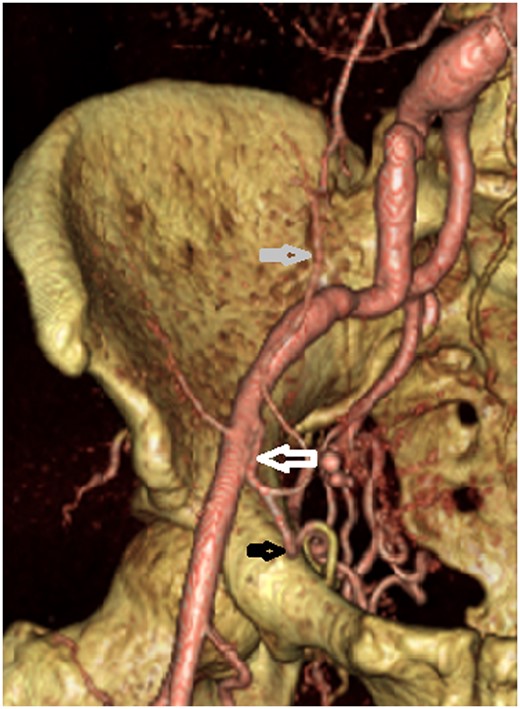 CT reconstruction showing corona mortis (white arrow) which connects the obturator artery (black arrow) and the inferior epigastric artery (grey arrow) with the external iliac artery.