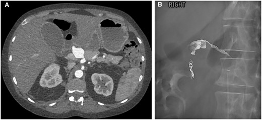 (A) Common hepatic artery (CHA) aneurysm. (B) Post-embolization showing coils in the gastroduodenal artery and onyx within the CHA aneurysm with some reflux proximally.