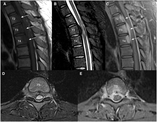 Sagittal T1 weighted (A), T2 STIR (B), and T1 weighted post-contrast (C) MRI images of upper thoracic spine demonstrated an enhancing infiltrative anterior epidural mass at T2 to T4 levels (white arrows) causing mild cord compression mainly at T3 level with cord oedema. Axial T2 STIR (D) and T1 weighted post-contrast (E) at T3 level showed that the epidural mass infiltrates into bilateral T3 lateral recesses and bilateral T3/4 intervertebral foramina (black asterisks). Enhancing lesions were also noted at the posterior aspect of T2 to T4 vertebral bodies (E).