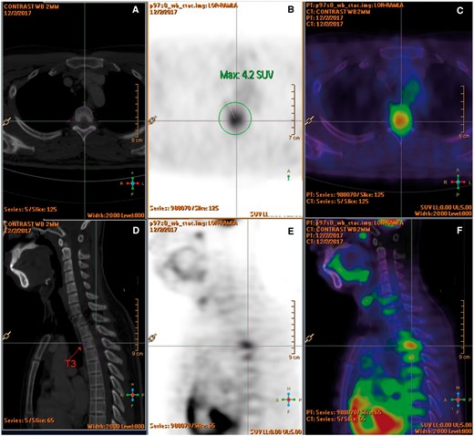(A-F) F-18 FDG PET-CT showed an intraspinal mass at T3 level with increased FDG uptake (SUV max 4.2). No overt bone erosion or extraspinal hypermetabolic lesion was detected.