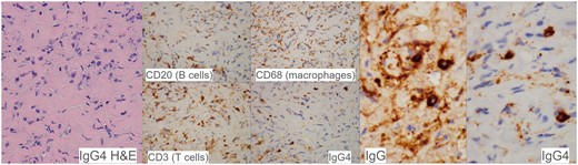 Histopathological findings in the epidural lesion. The lesion consists of fibrotic tissue with lymphoplasmacytic infiltrate between lamellated collagen fibres. The inflammatory cells comprise a mixture of B and T lymphocytes, plasma cells and macrophages. The plasma cells were mostly positive for IgG4, with an IgG4: IgG ratio >90%. Pathological diagnosis was IgG4-related fibro-inflammatory lesion.
