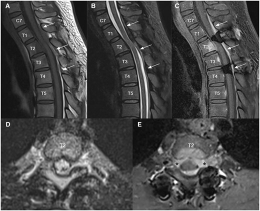 Follow up MRI 3 months after clinical recurrence upon low dose corticosteroid for a few years. Sagittal T1 weighted (A), T2 STIR (B), and T1 weighted post-contrast (C) MRI images of upper thoracic spine demonstrated a new enhancing infiltrative posterior epidural mass at C7 to T4 levels (white arrows) causing mild cord compression mainly at T2 level with cord edema. Axial T2 stir (D) and T1 weighted post-contrast (E) at T2 level showed that the epidural mass infiltrates into bilateral T2 lateral recesses and bilateral T2/3 intervertebral foramina (black asterisks). A new enhancing lesion was also noted at the posterior aspect of T2 vertebral body with overlying thin anterior epidural thickening (C, E). Mild residue T2 STIR hyperintense signal intensity (B) in the spinal cord at T3 level was compatible with old insult.