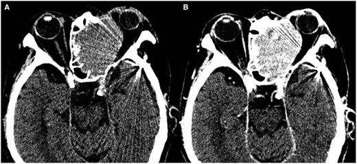 (A, B) Follow-up CT after biopsy on the day 14 of admission. Non-contrast CT shows a homogeneous high-density mass in the left ethmoid sinus extending to the left orbit (A). Contrast-enhanced CT shows homogenous enhancement in the tumour (B).