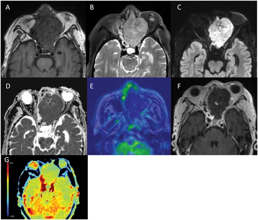 (A-G) MRI on day 16 of admission. The tumour in the left ethmoid sinus shows an isointense signal in comparison to muscle on T1WI (A), a hyperintense signal on T2WI (B), and a hyperintense signal with a low ADC value (mean ADC value 0.72 × 10−3 mm2/s) on DWI (C, D). Arterial spin label perfusion-weighted imaging (ASL-PWI) shows a hypointense signal in the tumour (E). Gd-T1WI shows an extensive unenhanced area in the tumour (F), suggesting spontaneous infarction of the tumour (E, F). APT-CEST imaging shows a slight hypointense signal in the unenhanced area within the tumour in comparison to normal brain parenchyma (G).