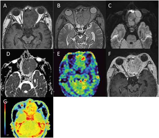 (A-G) MRI three months after admission. MRI shows a recurrent tumour in the left ethmoid sinus with an isointense signal in comparison to muscle on T1WI (A), hyperintense signal on T2WI (B) and a hyperintense signal with a low ADC value (mean ADC value 0.91 × 10−3 mm2/s) on DWI (C, D). On ASL-PWI, the signal of the tumour is isointense in comparison to normal brain parenchyma (E) and Gd-T1WI shows homogeneous enhancement (F). APT-CEST imaging shows a hyperintense signal in the tumour in comparison to the normal brain parenchyma (G).