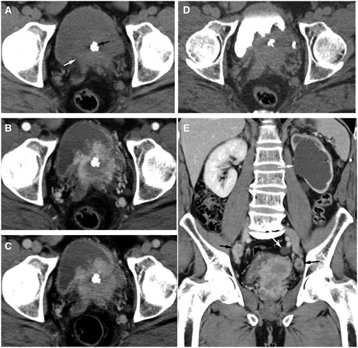 (A) The cross-sectional image of the plain CT shows an isodense soft tissue mass with ill-defined border in the prostate (white arrow), the CT value was 40 HU, and nodular calcification (black arrow) could be seen within the mass. (B-D) Axial contrast-enhanced CT images showed that the tumour invaded the left bladder trigone and bilateral seminal vesicles, and the tumour showed heterogeneous and significant enhancement with a visible patchy area of low-density necrosis in the center. The CT values of the most significant enhancement area on the renal cortical phase (B) and parenchymal phase (C) were 150 and 113 HU, respectively. On the renal excretory phase (D), nodular filling defects were observed in the bladder cavity. (E) Coronal reconstructed image of the enhanced CT showed severe left hydronephrosis and hydroureter (white arrow), with multiple enlarged lymph nodes in the pelvis. The left side are located in the region of the obturator lymph nodes and the right side are located in the region of the internal and external iliac lymph nodes (black arrow). The short diameter of the largest lymph node was 19 mm. The enhancement pattern of lymph node was similar to the primary prostate tumour. The plain CT value was 39 HU, and the CT values of the most significant enhancement area on the renal cortical phase and parenchymal phase were 162 and 106 HU, respectively.