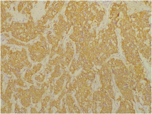 Immunohistochemical staining for synaptophysin is positive in tumour cells.