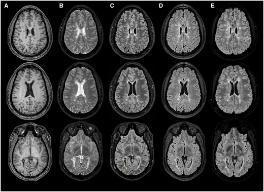 Select sequences from a 3-Tesla MRI of the brain. (A) Axial T1-weighted and (B) T2-weighted images of the brain revealing multi-focal regions of signal abnormality in locations typical for multiple sclerosis (MS). (C) Axial T2-fluid attenuated inversion recovery (FLAIR) fat-suppressed images demonstrating regions of T1-hypointensity within lesions (yellow arrows). Note the different characteristics in lesions from the FLAIR imaging sequence (D) and the fat-suppressed T2-FLAIR mismatch (B compared to C). (E) Axial FLAIR star MRI images of the brain highlighting the “central vein sign” within selected lesions in (C). The number of lesions with central vessels present suggest an origin of MS.