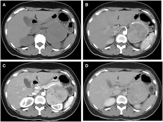 (A) Pre-contrast, (B) early arterial, (C) late arterial, and (D) equilibrium-phase CT. On pre-contrast CT, the tumour is isodense compared to the muscle, and there is no calcification. The dorsal portion of the tumour has a peak of contrast in the late arterial phase, with washout in the equilibrium phase. The ventral portion of the tumour gradually enhanced until the equilibrium phase.