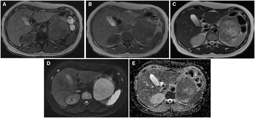 MRI of the tumour. (A) out-of-phase, (B) in-phase, (C) T2WI, (D) DWI b = 800, and (E) ADC images. The lesion is almost isointense to muscle on T1WI, without the fat component. It has a slightly higher intensity than muscle on T2WI; however, the dorsal portion of the tumour is slightly lower in signal than the ventral one. The central portion has the highest T2 intensity. The ADC of the dorsal portion is lower than that of the ventral portion. Abbreviations: ADC = apparent diffusion coefficient; T1WI = T1-weighted imaging; T2WI = T2-weighted image.