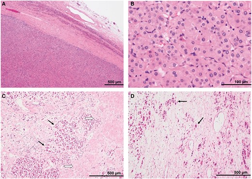 Pathological findings: H-E stain (A) peripheral portion of the tumour, (B) high-power field, (C) ventral portion of the tumour, and (D) dorsal portion of the tumour. (A) The tumour was a well-circumscribed mass encapsulated by a thick fibrous capsule. Compressed non-neoplastic adrenal tissue was seen around the tumour. (B) The tumour cells had eosinophilic cytoplasms and relatively uniform, small round nuclei. (C) The gradually enhanced areas on the equilibrium phase of the enhanced CT revealed fibrosis (black arrows) surrounding the tumour nests (white arrows). (D) In the area with a high signal intensity on T2WI, eosinophilic tumour cells (arrows) were scattered within the oedematous tissues with a low cellular density. Abbreviations: H-E = haematoxylin-eosin; T2WI = T2-weighted image.