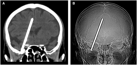 CT shows a nail inside the patient’s cranial cavity. (A) Coronal CT image and (B) CT scout image.