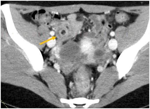 Axial CECT image through the right lower abdomen demonstrating target sign due to mesenteric fat telescoping into a bowel segment (arrow).