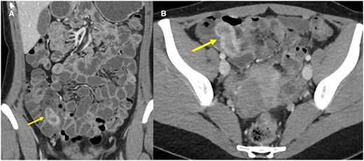 Coronal (A) and axial (B) CT enterography images demonstrate a blind-ending tubular structure with enhancing walls within the caecum (arrows).