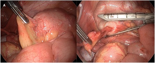 Intraoperative images (A and B) show partially reducible appendiceal intussusception.