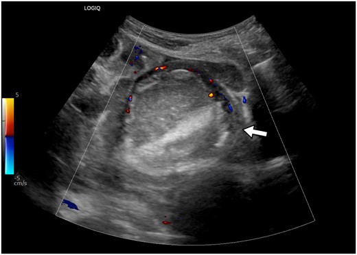 Ultrasonogram of the pelvis shows a well-defined, hyperechoic mass in the left adnexa, without internal vascularity. The left ovarian stroma is demonstrated at the periphery, showing vascularity on colour Doppler (arrow).