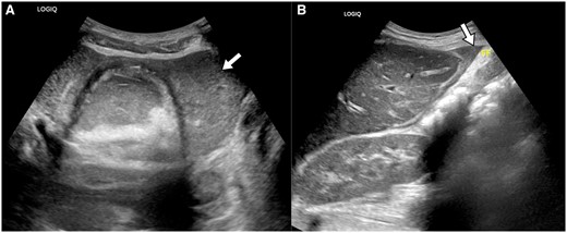 (A) Ultrasonogram of the pelvis shows echogenic fluid surrounding the left adnexal mass (arrow). (B) The echogenic fluid is also seen at the anterior surface of the liver (arrow). This echogenic fluid may represent blood or lipid laden fluid within the peritoneal cavity.