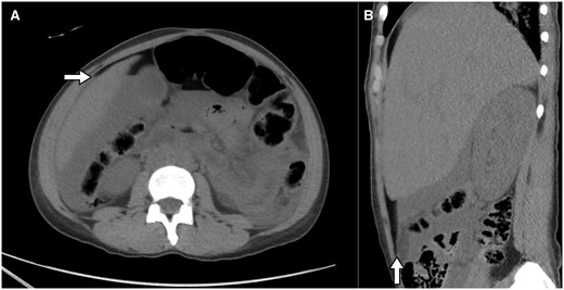 Axial CT section at the level of the upper abdomen (A) and right parasagittal reformation (B) shows fluid attenuation in the dependent areas, and fat attenuation in the non-dependent areas, forming a fat- fluid level. The anterior margin of the liver (arrow in (A)) is surrounded by the fat attenuation fluid.