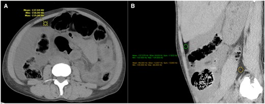 (A) Axial CT section at the level of the mid abdomen shows dependent high attenuation fluid, filling the right paracolic gutter, and non-dependent low attenuation fat towards the anterior abdominal wall, forming a fat-fluid level. A region of interest (ROI) in the non-dependent fluid, shows attenuation value of −137 Hounsfield Units (HU), suggestive of fat. (B)This non-dependent fluid has a lower attenuation value than the mesenteric or retroperitoneal fat (−98 HU). This fluid was consistent with the lipid laden peritoneal fluid that was found on laparotomy.
