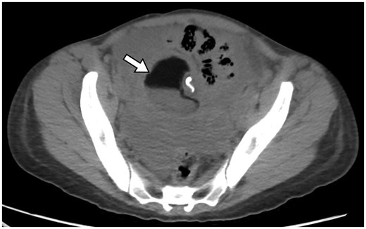 Axial CT section at the level of the pelvis shows a mass in the right adnexa with internal fat, fluid, and calcifications, consistent with a dermoid cyst. There is an internal fat-fluid level. There is also hemorrhagic fluid surrounding the cyst in the pelvis.
