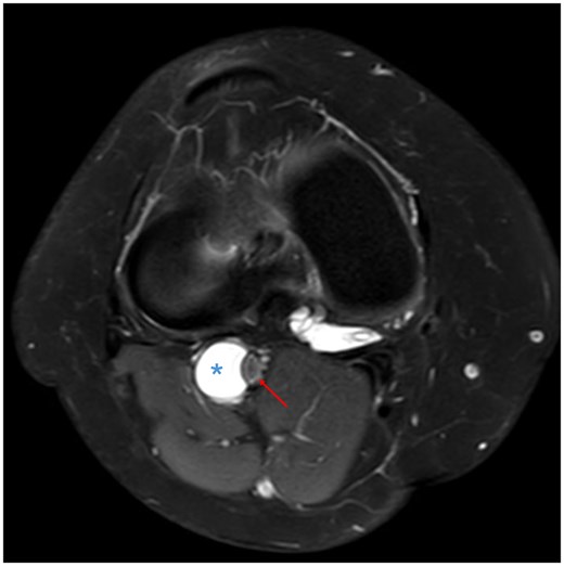 Axial proton density fat saturated sequence illustrating the cyst being related to the outer wall (adventitia) of the popliteal artery (asterisk), measuring approximately 14 mm in diameter, and causing popliteal artery stenosis (red arrow) with preserved flow void.