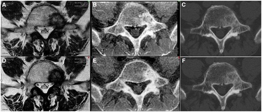 Comparison of images before and after radiation therapy. Panels A and D show T2-weighted images; panels B and E show CT-like magnetic resonance images, and panels C and F show plain CT images. Panels A, B, and C show images before radiotherapy for bone metastasis, whereas panels D, E, and F show images after radiotherapy. Panels B and E show an increase in the area of bone sclerosis before and after radiotherapy.