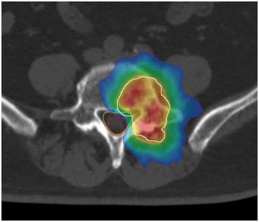 Dose colour wash of the radiotherapy. White line, PTV; red line, cauda equina; yellow line, spinal canal. (Red area) The prescribed dose is delivered to 105% of the PTV. (Yellow area) The prescribed dose is delivered to 100% of the PTV. (Green area) The prescribed dose is delivered to 95% of the PTV. (Blue area) The prescribed dose is delivered to 50% of the PTV.