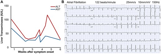 Elevated transaminases and new-onset atrial fibrillation. (A) In this patient with normal baseline liver function presenting 4 weeks after symptom onset, liver enzymes exhibited a temporally biphasic elevation, with ALT > AST. (B) At our hospital, he had new-onset atrial fibrillation with ventricular response rate of 120 to 150 beats/min on electrocardiogram.