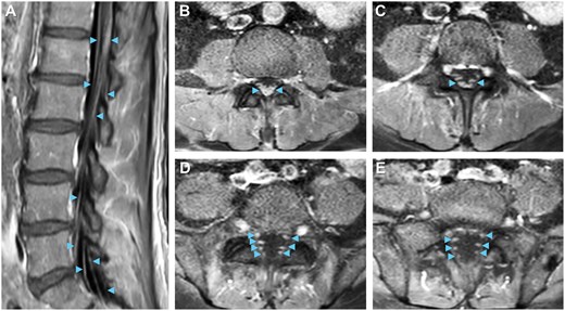 Neuroimaging visualizes lumbar polyradiculitis. Enhancement of bilateral cauda equina nerve roots (arrowheads) near L1-L5 on (A) sagittal and (B-E) descending axial slices supports the diagnosis of lumbar polyradiculitis on T1 post-contrast MRI.