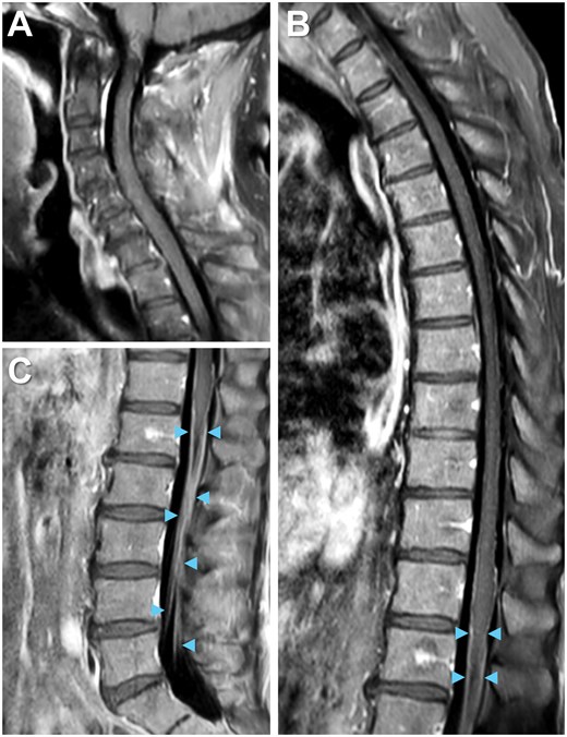 Complete spine imaging on MRI. The majority of contrast enhancement is not readily seen in the (A) cervical or (B) thoracic but rather the (C) lumbar region on T1 post-contrast spine imaging. Enhancement of bilateral cauda equina nerve roots (arrowheads).