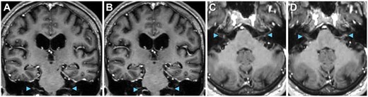 Cranial nerves on MRI. Suggestion of cranial nerve involvement (arrowheads), including cranial nerve V on (A and B) coronal and (C and D) axial T1 post-contrast MRI.