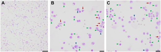 CSF cytology illustrates lymphocytic pleocytosis. Air-dried hematoxylin-eosin stained CSF micrographs at (A) 10× (scale bar 100 μm) and (B and C) 40× (scale bar 20 μm) indicate lymphocytic pleocytosis (arrows) with abundant polymorphous lymphocytes (green arrowheads) and plasma cells (blue arrowheads) with occasional neutrophils (red arrows).