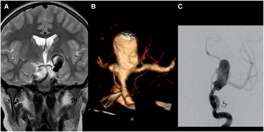 (A) Coronal T2-weighted image of an MRI performed for unspecific headache in the then 10-year-old boy. It shows a giant and partially thrombosed aneurysm of the left ICA. There is no oedema but mass effect on the third ventricle. (B) The CTA shows the broad-based aneurysm incorporating the carotid termination. There is no A1 segment. The left M1 segment originates from the aneurysm. A smaller lobule is seen pointing medially. The internal surface of the aneurysm appears coarse. (C) The diagnostic angiogram shows contrast pooling in the aneurysm before filling theMCA. Abbreviation: ICA = internal carotid artery; CTA = CT angiography; MCA = middle cerebral artery.