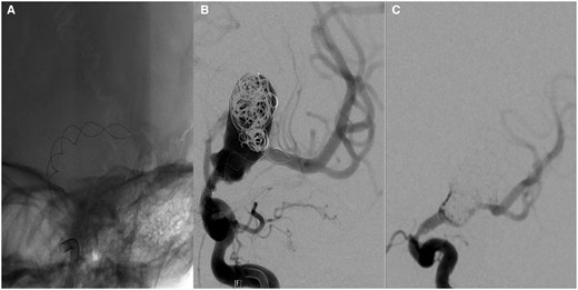(A) A Leo 3.5 × 35 mm braided stent was deployed across the aneurysm neck with some difficulty. The cannulation of the M1 was impaired by the rough lining of the aneurysm and the acute angle of the M1 exit. (B) Some coils were added during the same sitting. Placement of a flow-diverting stent would have required the passage of the stent which was regarded as too risky due to possible stent dislocation into the aneurysm. (C) Four months later, the aneurysm was packed more densely with coils. No stent was added because of intimal hyperplasia in the Leo stent.