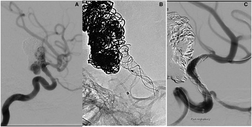 (A) An additional 6 months later, the boy returned for further treatment as an MRI had shown aneurysm recurrence. The diagnostic angiogram was thought to show resolution of the intimal changes. It was possible to advance a microcatheter into the left M1 without problems. (B) Deployment of the SILK flow-diverting stent. The proximal end of the stent does not open. The ICA occludes and it is not possible to advance the microcatheter over the stent delivery wire. (C) After angioplasty with a Maverick coronary balloon flow is restored after 5 h. There remains a significant residual stenosis. Abbreviation: ICA = internal carotid artery.