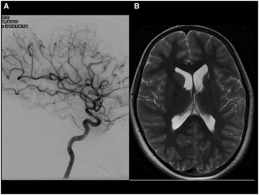 (A) The check angiogram 18 months after insertion of the flow-diverting stent shows aneurysm occlusion with a persistent in stent stenosis. (B) The MRI 12 months later and after discontinuation of all antiplatelet agents shows post ischaemic atrophy of the left-sided basal ganglia. The aneurysm has further shrunk. There was no new ischaemia (not shown).