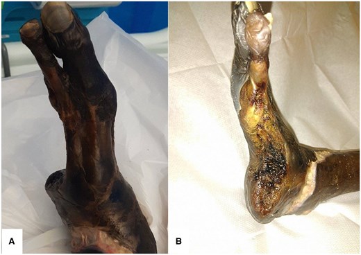 Initial photographs (A and B) demonstrate previous amputations of the third to fifth toes, the side view displays necrotic appearance of the superficial wound with peripheral blistering.