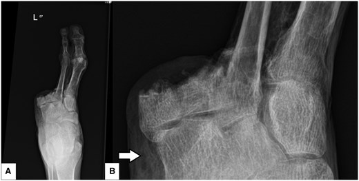 Left foot anteroposterior (AP) projection plain radiograph (A) and scaled-up view (B) demonstrating third to fifth toe amputation, soft tissue emphysema adjacent to the tarsal bones (arrow) and heterogenous trabecular bony pattern throughout, particularly within the remaining metatarsals.