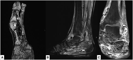 MRI of the left foot. Axial T1 weighted sequence slice (A) shows multiple rounded hypo-intensities/signal voids in the trabecular bone (arrow). Sagittal T2 STIR sequence slice (B) again demonstrates the same rounded hypo-intensities to a lesser extent as well as extensive soft tissue and intramuscular oedema (arrow). Coronal proton-density (PD) fat-saturated image slice (C) again demonstrated abnormality throughout the tarsal bone trabecula and surrounding soft tissues as well as the involvement of the tibiotalar joint (arrow).