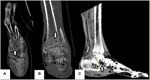 CT of the left foot. Axial (A) and coronal (B) slices view bony windows demonstrating locules of intraosseous gas demonstrated within the mid and forefoot, distal tibia, and fibular bones (arrows). Sagittal soft tissue window slice (C) displays a further locule of gas at the sinus tarsi and tracking along the soft tissues up to the mid to distal calf level (arrow).