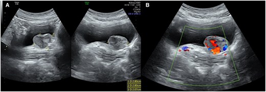 (A) Ultrasound image of the bladder showing the paraganglioma with corresponding size of 2.80 × 2.80 cm. (B) Colour doppler of the mass demonstrates increased vascularity of the lesion. Images were taken from the Gold Coast PACS system.
