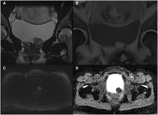 (A) A T2 image showing a well-defined lesion from the anterior bladder wall with homogenous T2 intermediate signal changes and hypointense foci representing internal vascularity, with (B) corresponding to the coronal view of the mass in T1 with mild hyperintensity. (C) An axial view in the DWI sequence showcasing the restricted diffusion of the mass. (D) The same lesion with hypointense signal on ADC map, further suggesting restricted diffusion. Abbreviations: ADC = apparent diffusion coefficient; DWI = diffusion-weighted image. Images were taken from the Gold Coast PACS system.