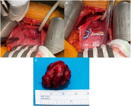 (A) The superior view from patient’s perspective of the lesion within the urinary bladder. Note the indwelling urinary catheter to the right of the lesion. (B) Similar perspective, with a double-J ureteric stent indicating the ureteric orifice location in relation to the bladder mass. (C) The surgical specimen measuring 2.5 cm, showing a well-circumscribed lesion. Images were taken from the Gold Coast PACS system.