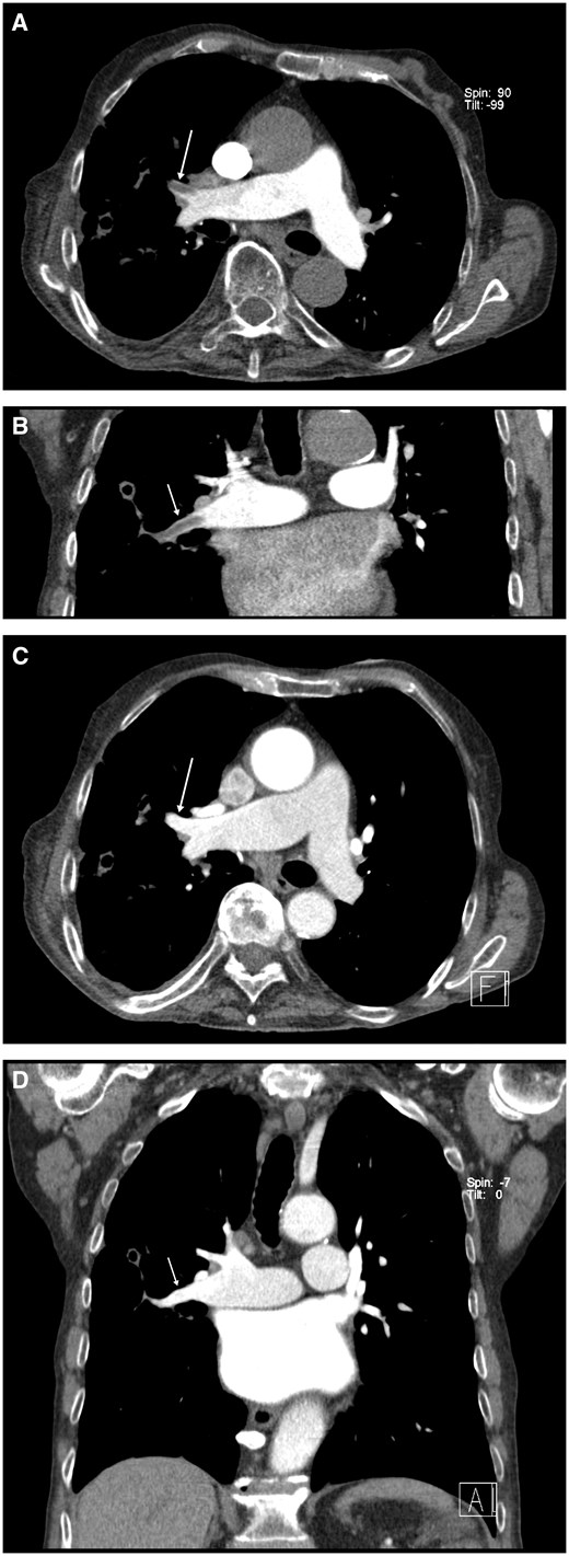 Contrast-enhanced CT. (A) Axial oblique plane: pulmonary phase with filling defects of middle lobe artery (arrow) consistent with pulmonary embolism (seemingly incomplete enhancement of the left posterior segmental artery due to partial volume effect). (B) Same situation in coronal oblique plane (arrow). (C) Axial oblique plane: aortographic phase with disappearance of filling defect (arrow). (D) Same in coronal oblique plane (arrow).