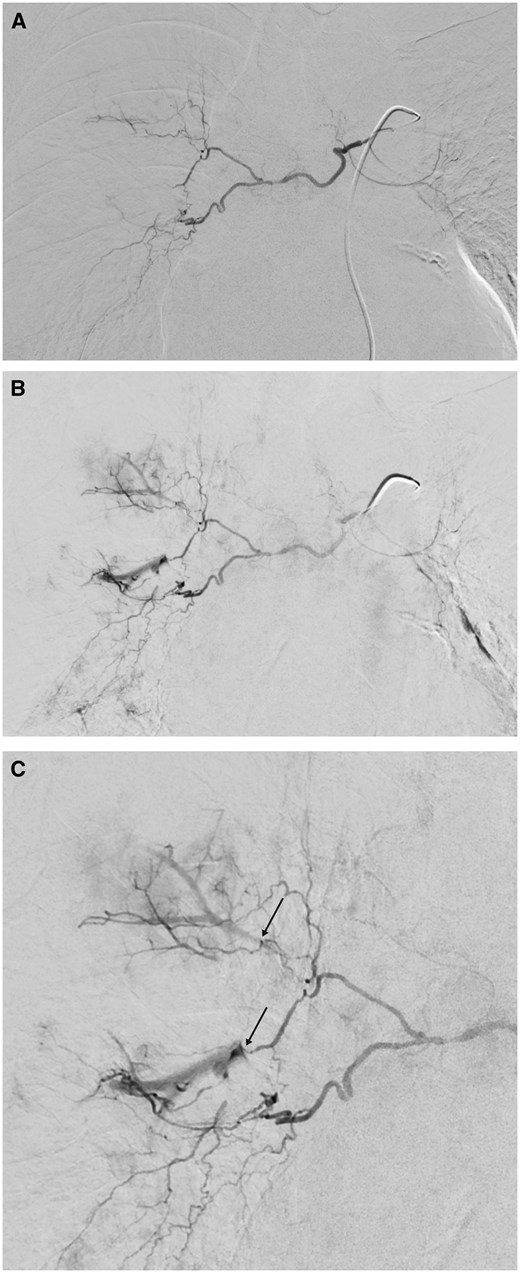 Arteriogram of right bronchial artery. Normal-sized right bronchial artery with common trunk with small left bronchial artery. (A) Early phase with no irregularities. (B) A few seconds later. Bronchial-to-pulmonary-artery fistula of right upper-lobe and middle-lobe artery. (C) Enlarged view (arrows indicate fistulas).