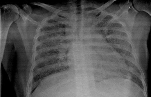 Case 1(a): Frontal chest radiograph showing multiple reticulonodular opacities in bilateral lung fields.