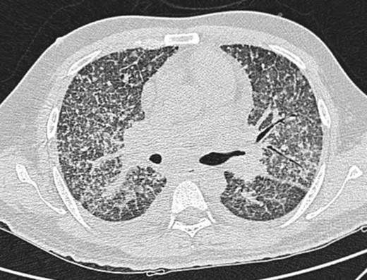 Case 1(b): CT scan of the chest in lung window shows multiple nodular opacities distributed along the peribronchovascular interstitium and subpleural regions (perilymphatic).