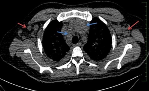 Case 1(c): CT scan of the chest in mediastinal window shows multiple enlarged axillary (red arrows) and mediastinal lymph nodes (blue arrows).